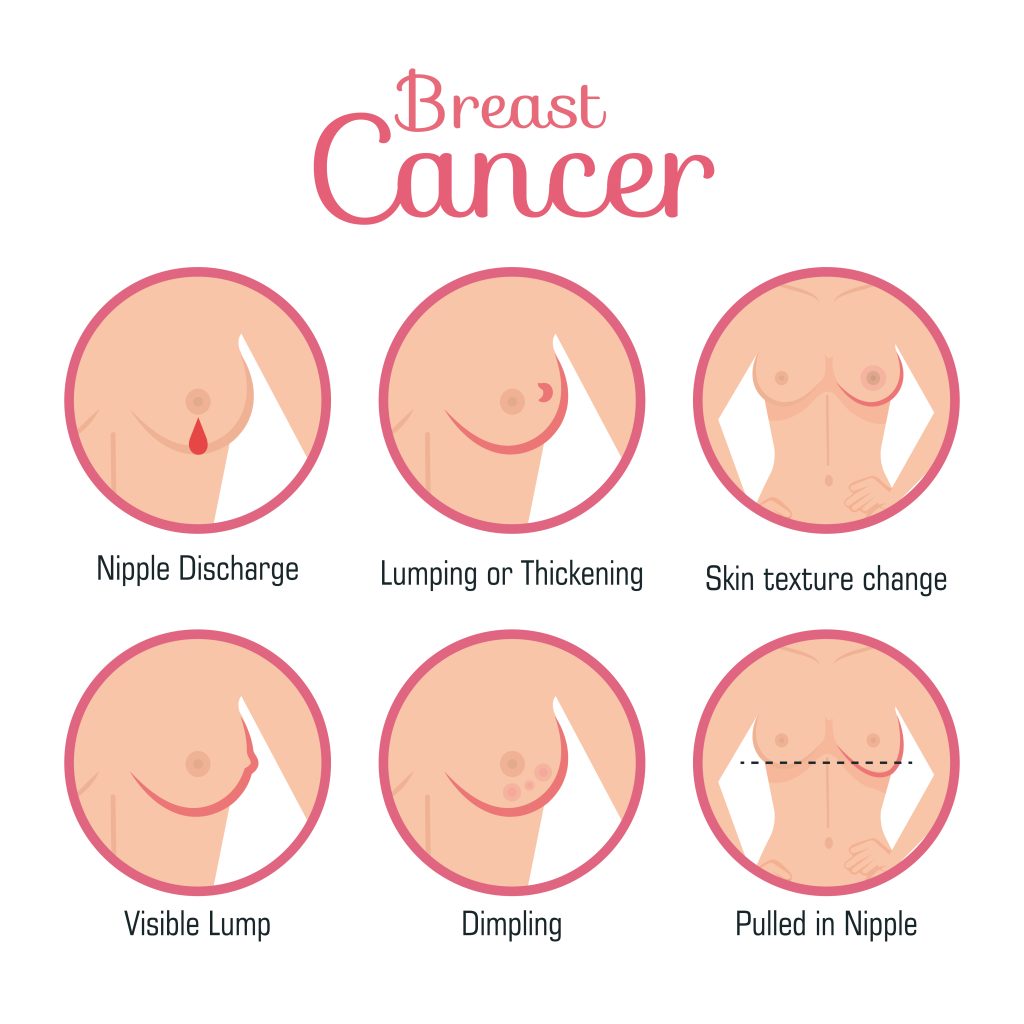 tipe atau jenis kanker payudara